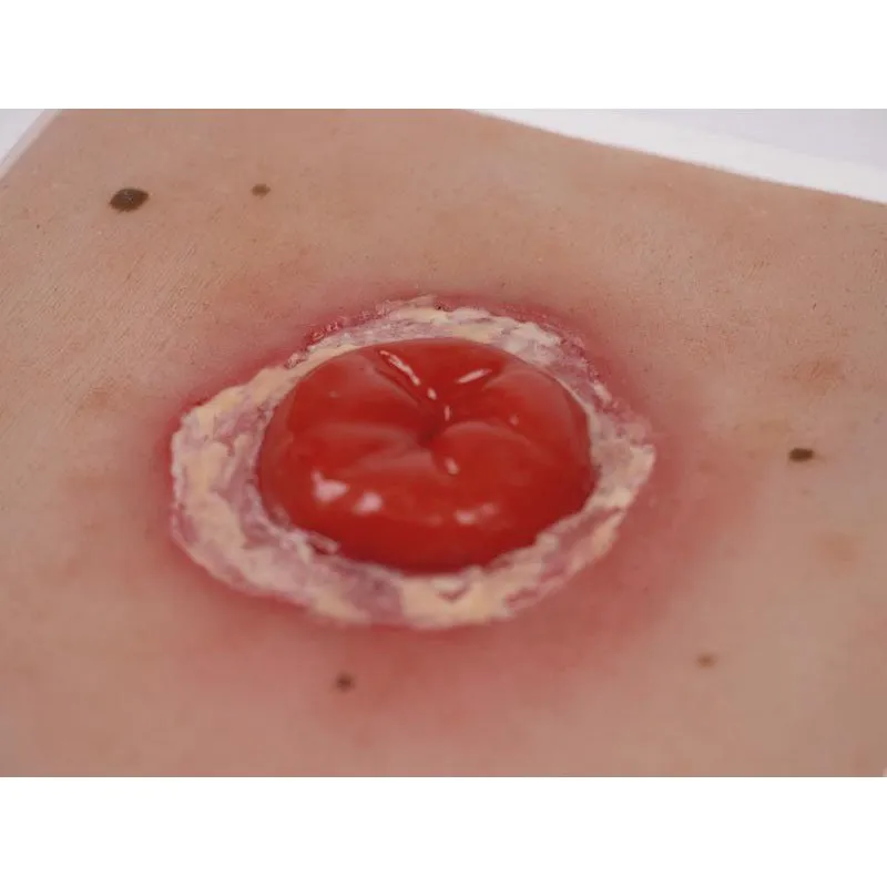 Wound Moulage Colostoma with Inflammation, incl. Stand