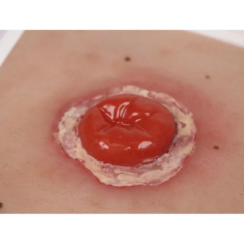 Wound Moulage Colostoma with Inflammation, incl. Stand